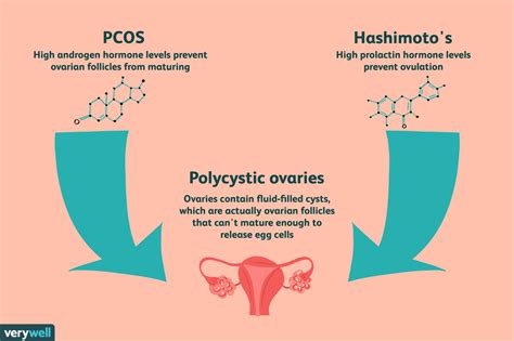 is there a link between pcos and hypothyroidism