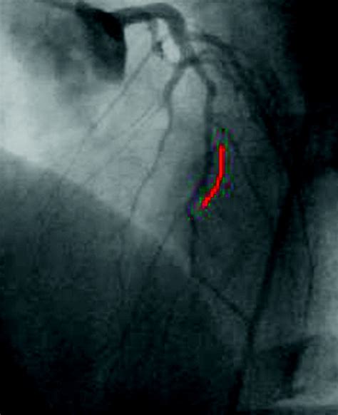 percutaneous coronary intervention ii  procedure  bmj