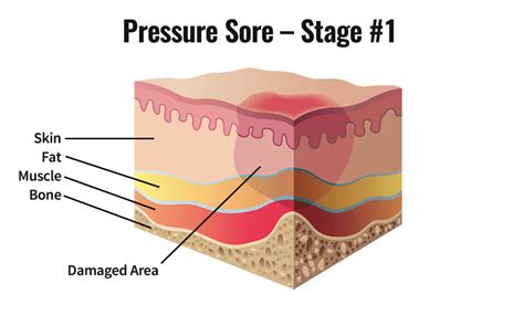 skin pressure sores  spinal cord injury