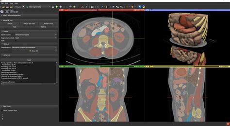 extension fully automatic  body ct segmentation   minutes  totalsegmentator