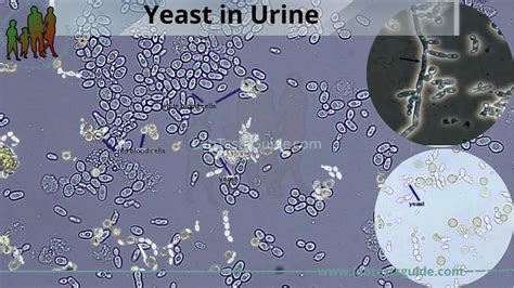 yeast  urine  symptoms diagnosis  treatment