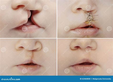 lip  palate cleft    surgery stock photo image  stage deformity