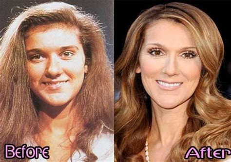 celine dion nose job before and after celebrity plastic surgery plastic surgery celebrities