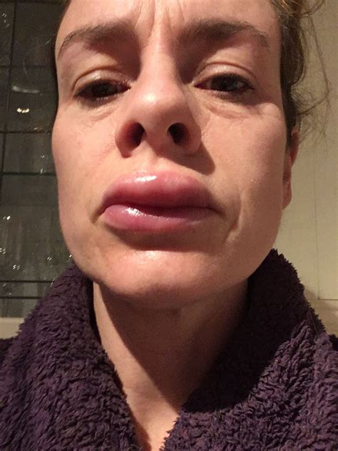 Mum Looked Like She Had “botched Lip Fillers” Following Allergic