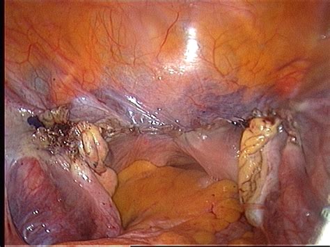 laparoscopic hysterectomy intechopen
