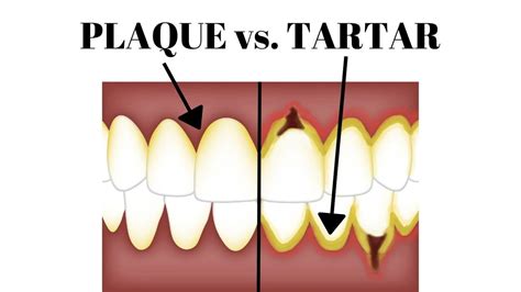 how to remove plaque vs tartar