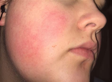 skin concerns routine   evening  red cheeks rskincareaddiction