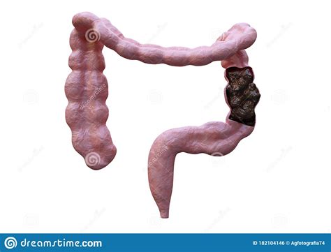 intestinal constipation bowel disorder characterized  difficulty