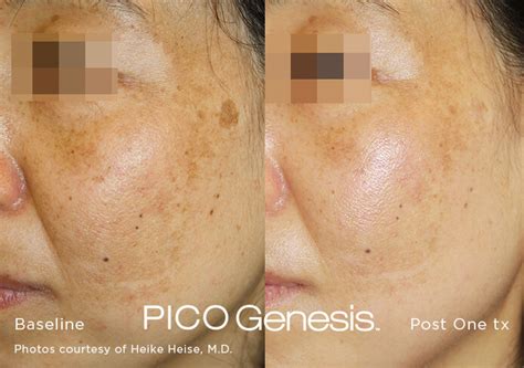 permanent dark spot removal pico genesis laser miami skin spa