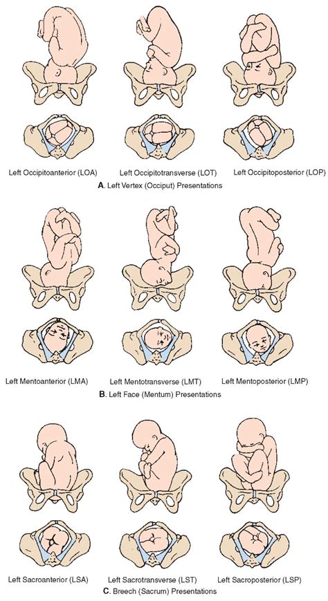 Nurseupdate Left Fetal Presentations