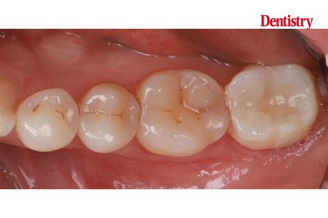 prosthodontips restoration     molar dentistry