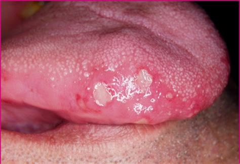 mild oral herpes pictures xxx pics