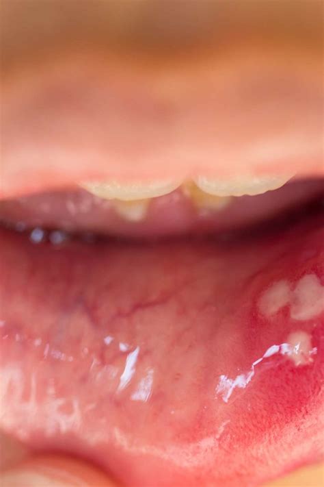 hpv tongue lesions