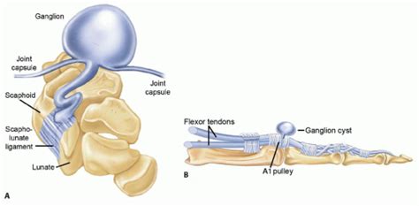 open  arthroscopic excision  ganglion cysts  related tumors