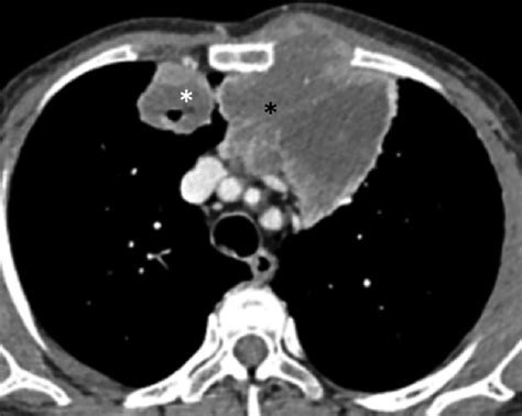 Mediastinal Lymph Node Involvement In Follow Up Computed Tomography