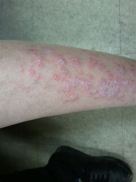 itchy rash   legs pictures