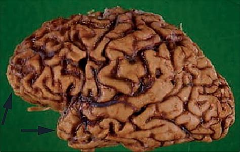 Frontotemporal Dementia The Lancet Neurology