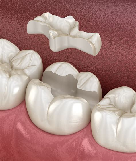 dental inlays dental onlays dental cavities