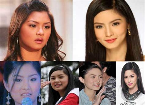 Kim Chiu Plastic Surgery Before And After Photos Plastic