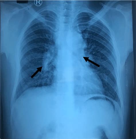 Chest Radiograph Showing Bilateral Hilar Adenopathy Right More Than