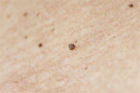 how to remove skin tags on your neck easily at home top