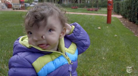 mom s emotional journey to mend 2 year old s face [video]