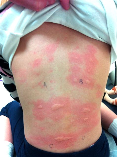 allergy atopy  infants children  adolescents