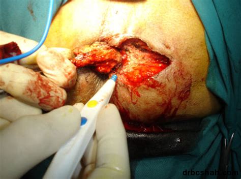 anal fistula repair causes symptoms treatment anal fistula repair