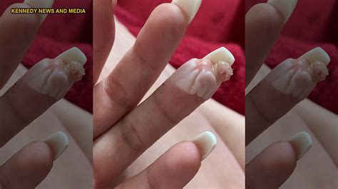 Woman Claims Botched Acrylic Nail Job Nearly Cost Her A Finger Ill