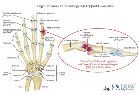 finger proximal interphalangeal pip joint dislocation rehab  patient