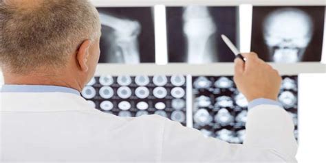 Osteoporosis In Men Under 50 Bone Health Other Diseases