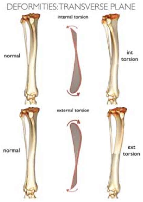 calendario fiscal  tibial torsion  femoral anteversion images imagesee