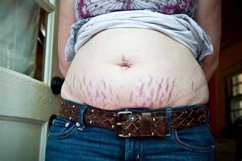 stretch marks with twin or triplet pregnancy multiple births twinfo