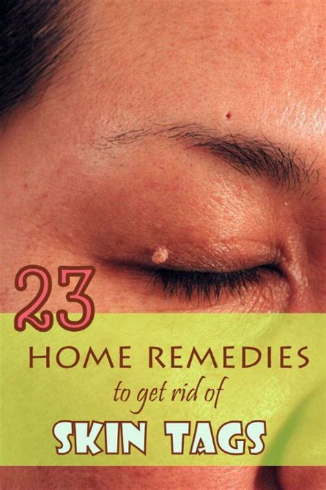 use safe ways to remove skin tags at home skin tags home remedies