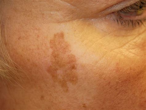 age spots  symptoms  treatment