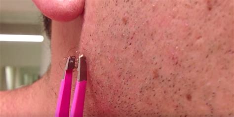 video the most watched ingrown hair removal on youtube