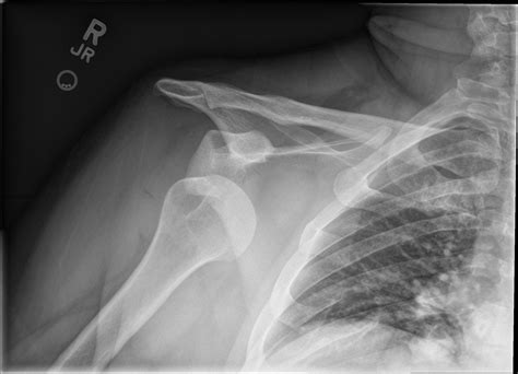 shoulder dislocation core em