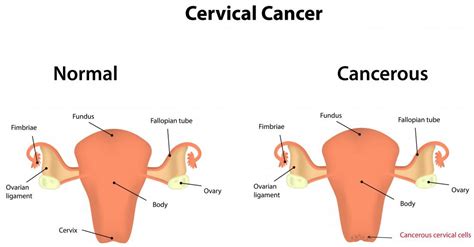 what are the signs of cervical cancer during pregnancy cervical