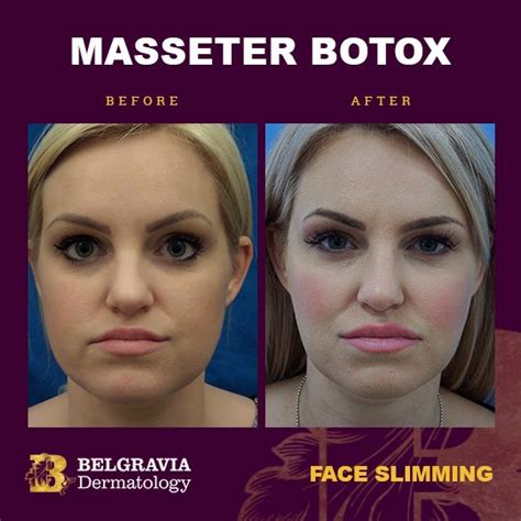 botox for masseter muscles in london for face slimming and