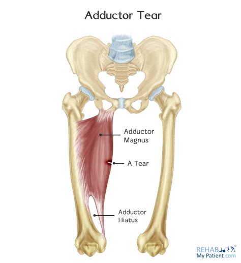 Adductor Tear Rehab My Patient