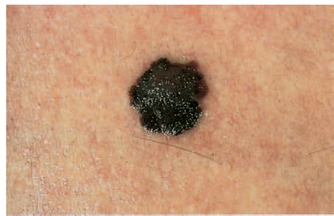 melanoma warning signs  images  skin cancer foundation