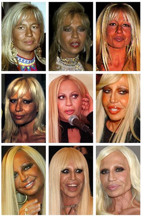 Donatella Versace Celebrity Plastic Surgery Beauty Hacks Plastic
