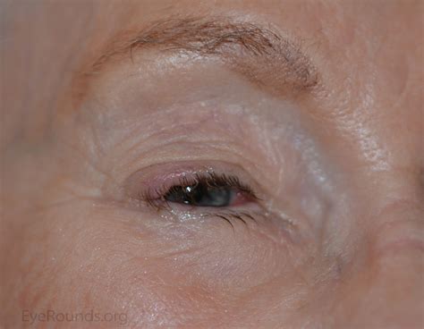 merkel cell carcinoma   eyelid