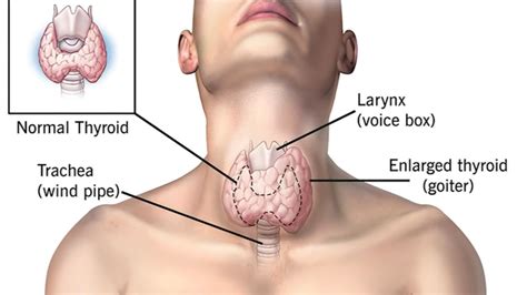 thyroid problems drgorantla
