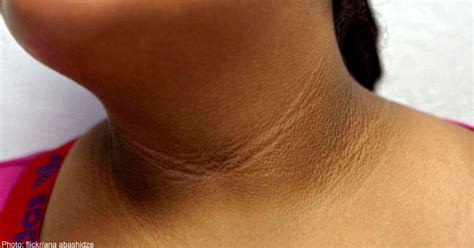 Acanthosis Nigricans Is A Leathery Skin Condition That S