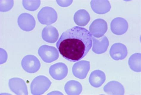 lgl leukemia unexplained sustained 6 month increase 2000