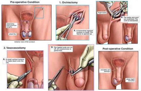 bilateral orchiectomy