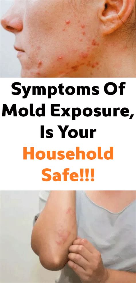 symptoms  mold exposure   household safe mold exposure symptoms  mold effects