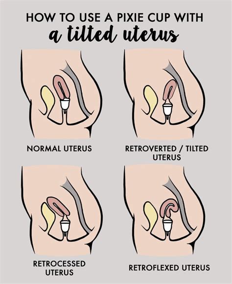 How Do I Use A Menstrual Cup With A Tilted Uterus Pixie Cup