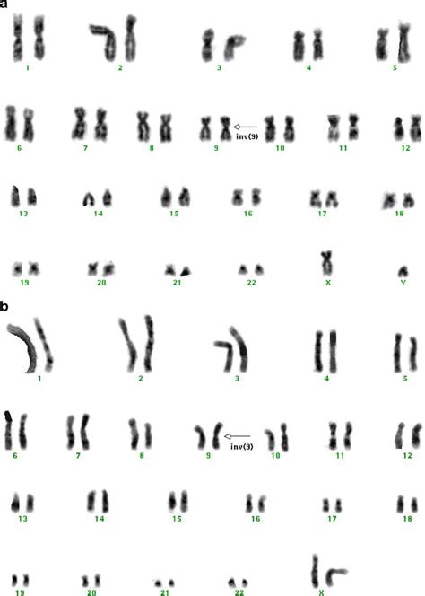 A B Karyotype 46 Xy Inv 9 P11 Q13 In A Case Of Transient